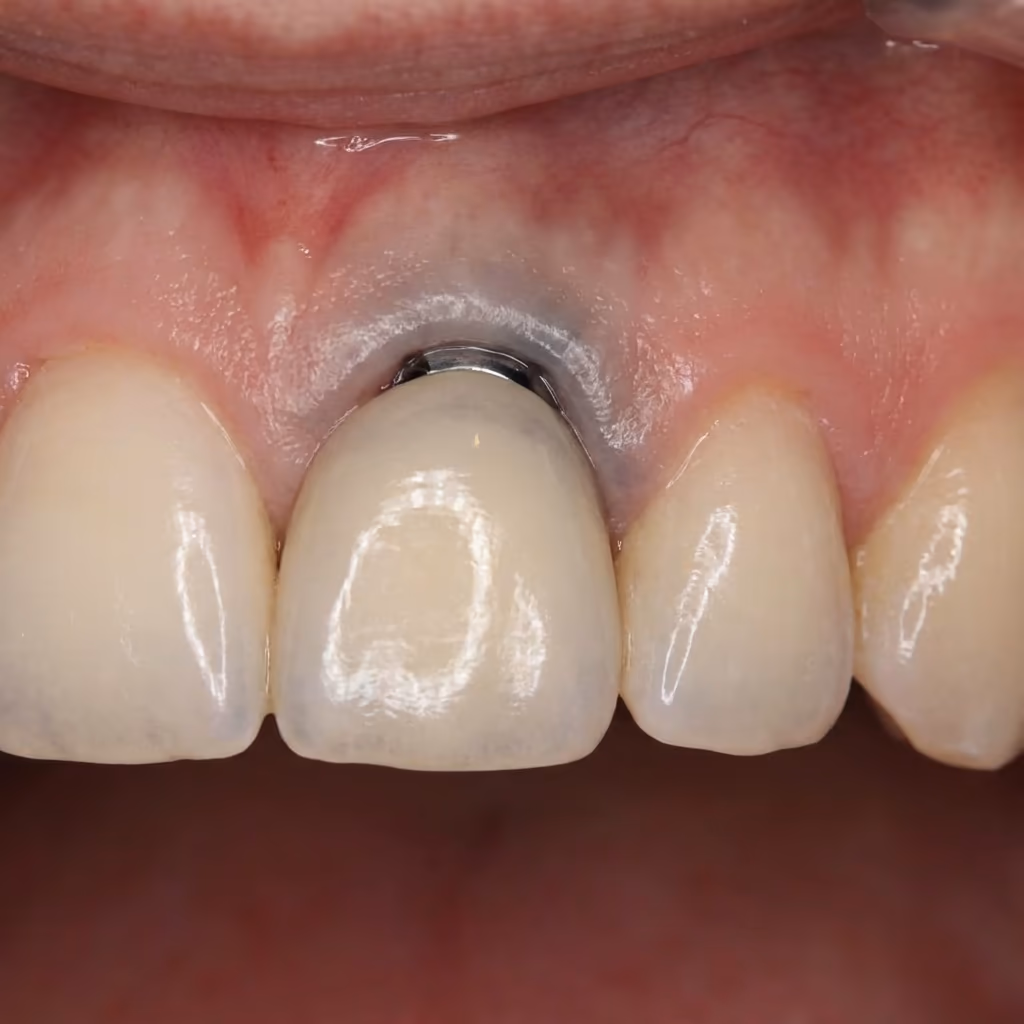Before - Rescue of Failed Anterior Implant